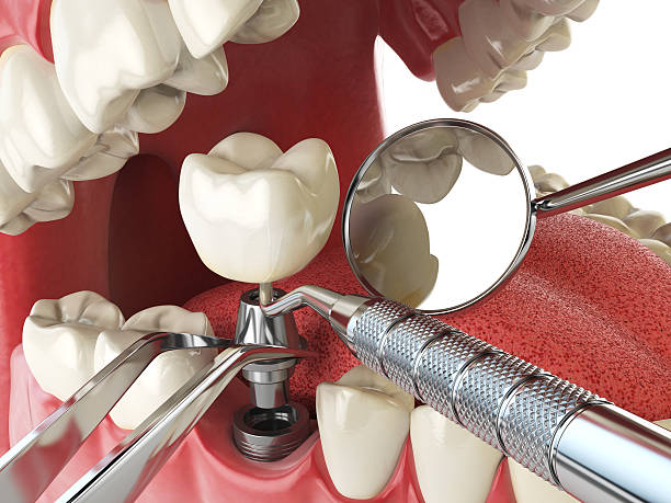 Best Emergency Wisdom Teeth Removal in Lafayette, GA